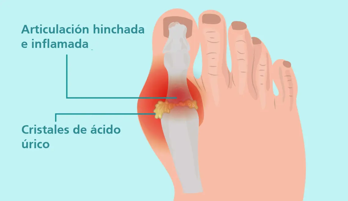 como eliminar cristales de acido urico - Cómo eliminar los cristales que se forman en las articulaciones