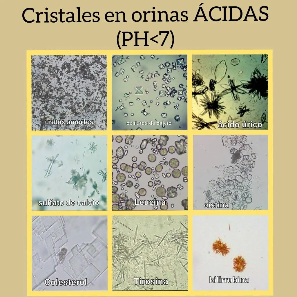 cristales en orina acida - Cuáles son los cristales de orina acida