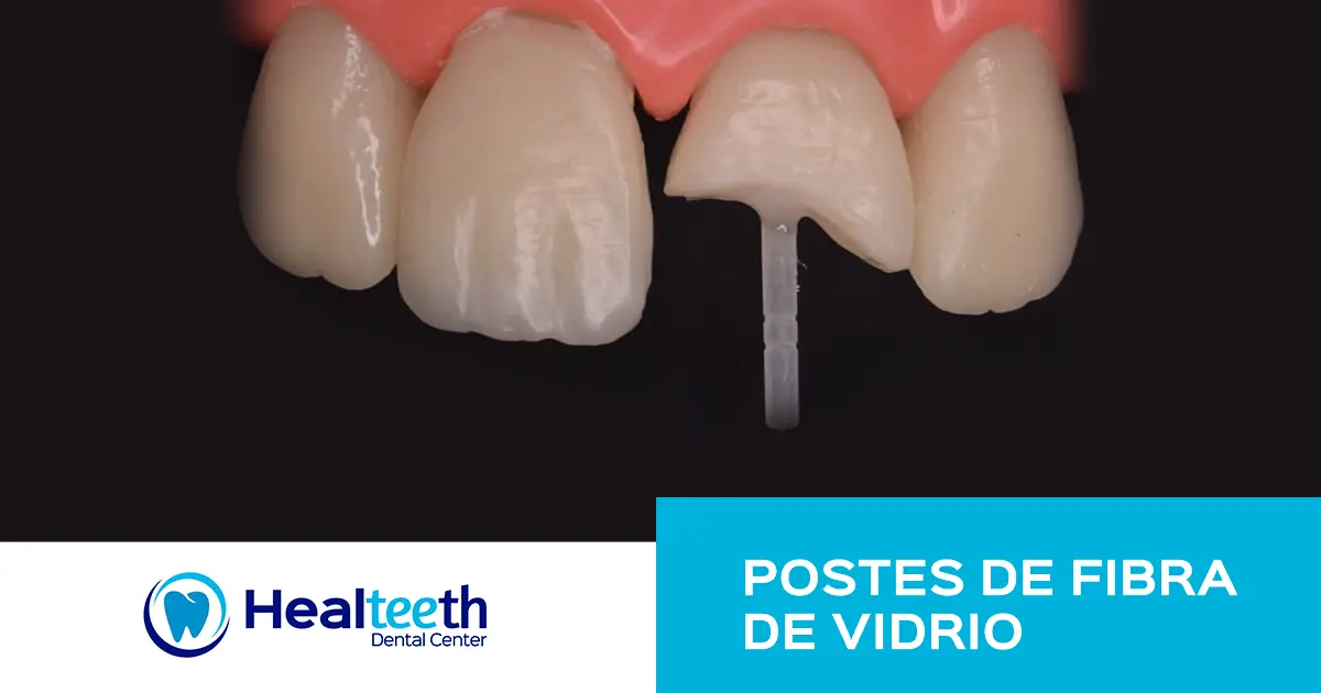 fibra de vidrio para dientes - Cuándo es necesario poner un poste dental