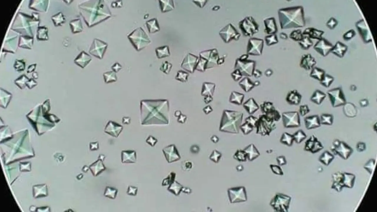 cristales de oxalato de calcio en orina - Cuando hay cristales de oxalato de calcio