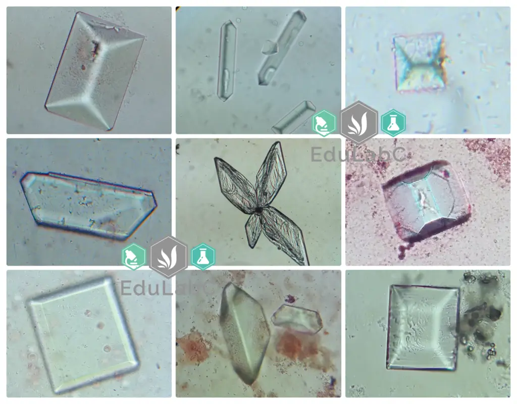cristales en orina alcalina - Cuántos tipos de cristales en orina existen