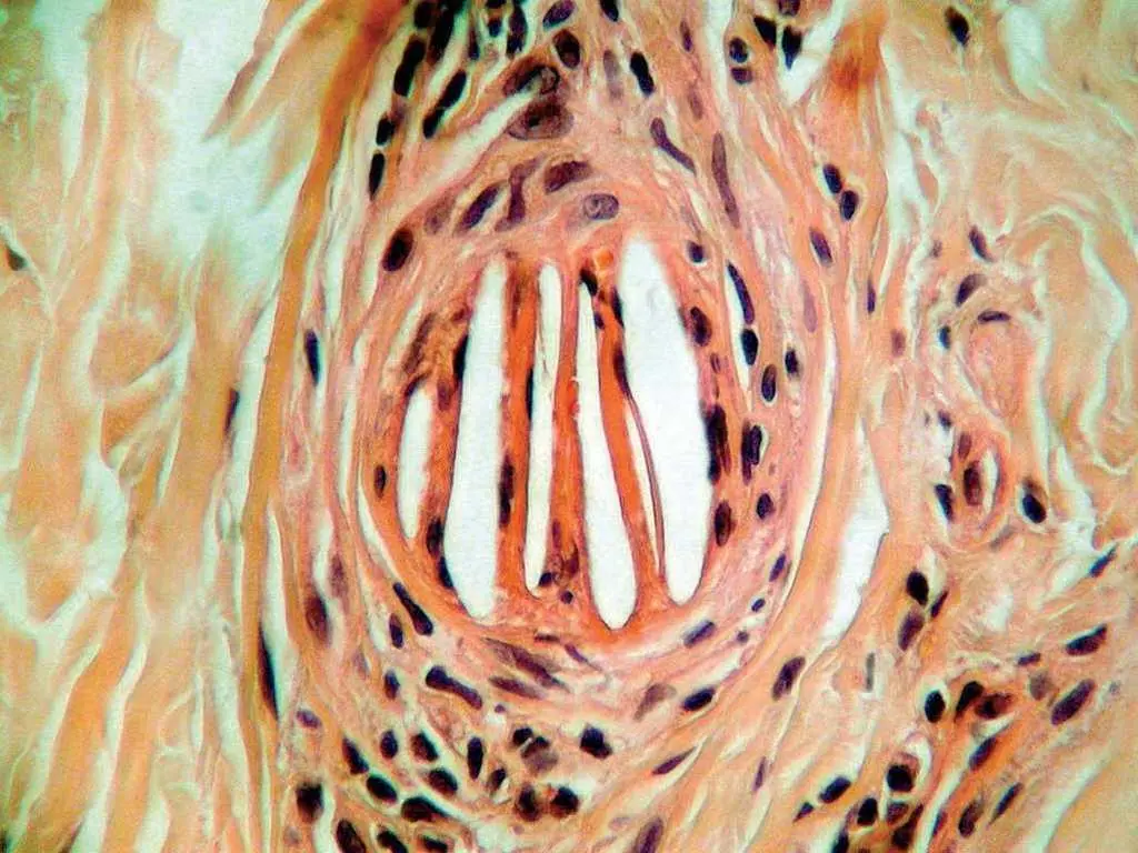 cristales de colesterol histologia - Qué es la Ateroembolia