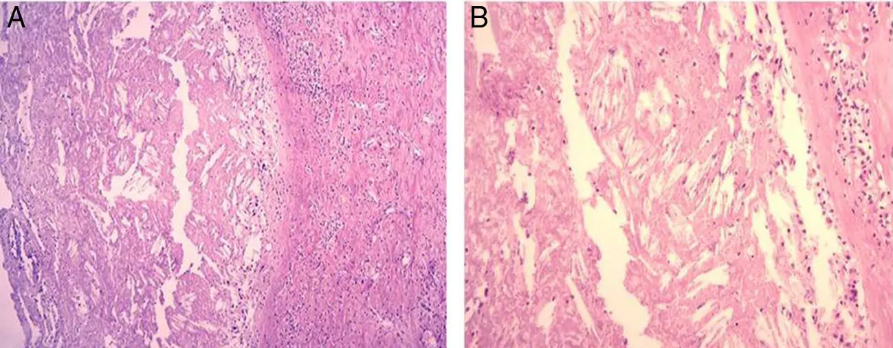 cristales de colesterol histologia - Qué es la embolia ateromatosa