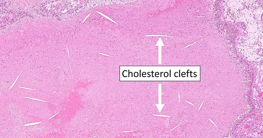 cristales de colesterol histologia - Qué forma tiene el cristal de colesterol