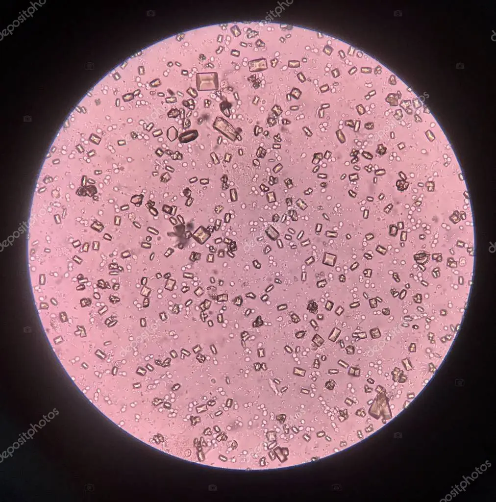 cristales en orina microscopio - Que se ve en la orina en el microscopio