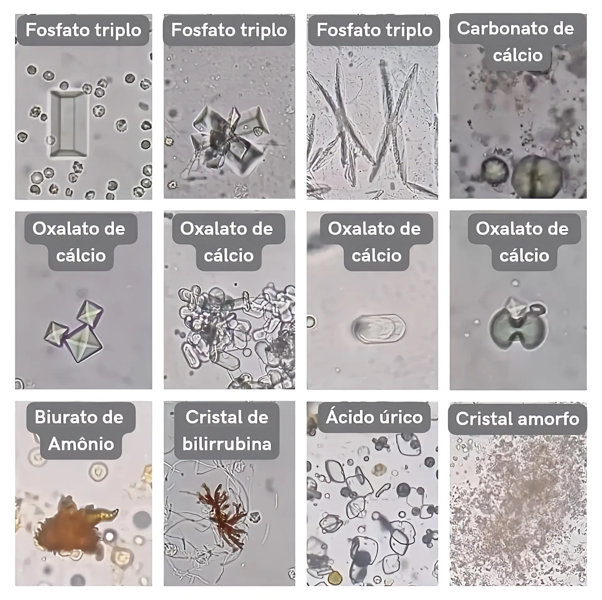 cristales carbonato de calcio en orina - Qué significa carbonato de calcio en la orina