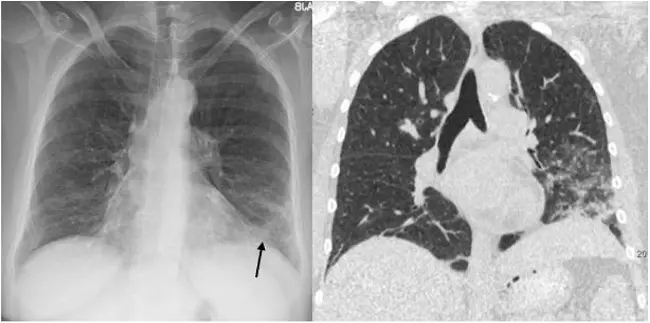 opacidad en vidrio esmerilado - Qué significa consolidacion alveolar