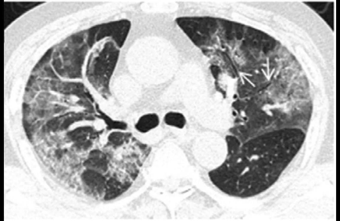 fibra de vidrio en los pulmones - Qué son las fibras vitreas